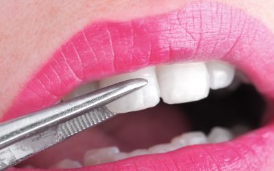 Lumineers vs Porcelain Veneers: Which Is Better for Your Smile?