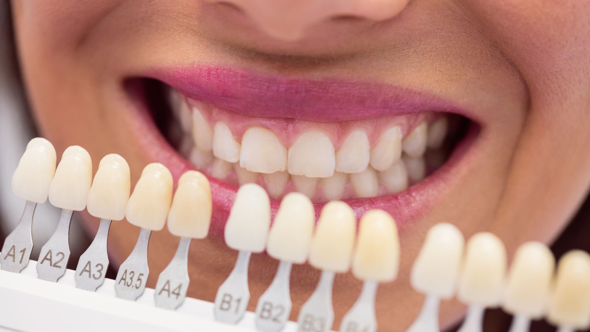 A patient smiling while a dentist is holding a teeth shade showcasing teeth whitening